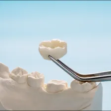 Dental Crowns Services at Comfort Dental Center in Los Angeles, CA
