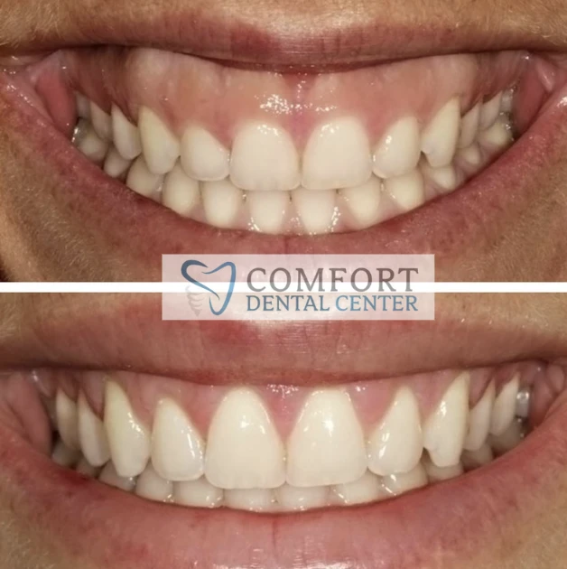 gummy-smile-showcase gallery